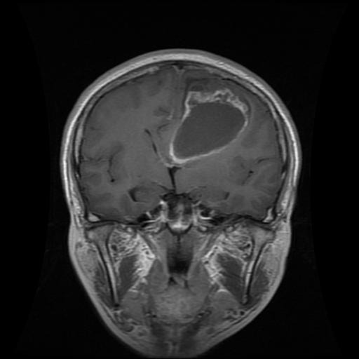 Sample MRI scan showing a glioma tumor