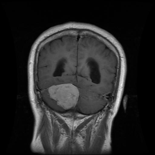 Sample MRI scan showing a meningioma tumor