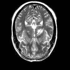 Sample MRI scan with no tumor