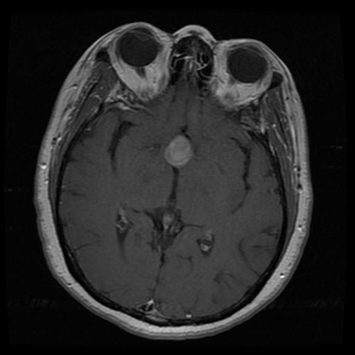 Sample MRI scan showing a pituitary tumor